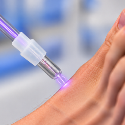 Hochfrequenzplasma bei der Anwendung am Fuß - die Plasmaentladung entsteht im feinen Luftspalt zwischen Glaselektrode und Haut
